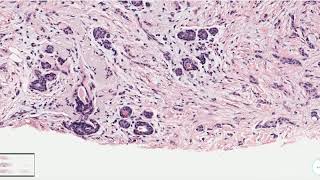 Breast Pathology  Infiltrating Lobular Carcinoma ILC [upl. by Dnalyr612]