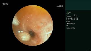 Endobronchial Carcinoid  Bronchoscopic retrieval [upl. by Day848]