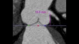 Vitrea Cardiac CT preprocedure TAVR planning [upl. by Losiram]