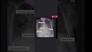 Pulmonary edema on chest xrayradiologykerleylinesCTR [upl. by Nnylahs]