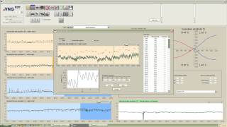 eVNG Caloric Settings [upl. by Bonn895]