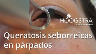 Queratosis seborreicas en párpados  Láser Lotus 16008 [upl. by Accissej]