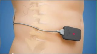 Spinal Cord Stimulation Screening Trial System [upl. by Satsoc]