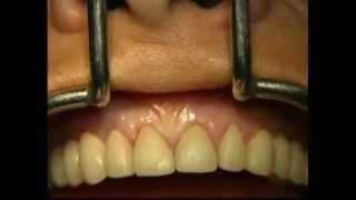 Gingival Surgery  Internal Bevel [upl. by Adnim17]