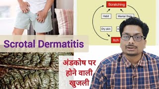 अंडकोष पर होने वाली खुजली का कारण  Part 1 Scrotal Dermatitis  Scrotal Eczema scrotaldermatitis [upl. by Lehacim460]