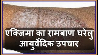 Health Tips एक्जिमा का रामबाण घरेलु आयुर्वेदिक उपचार  Charm Rog  Eczema ka Gharelu Upchar [upl. by Janette]