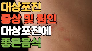 건강대상포진 증상 및 원인대상포진에 좋은 음식심한 통증 단순포진 마늘 버섯 견과류 등푸른생선 홍삼 양파 녹황색채소 생강 보리 [upl. by Foote]