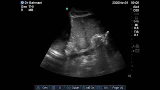 Case 89  Hyperechoic liver lesions [upl. by Phillada]