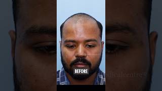 Hair transplant results after 12 months  best hair transplant clinic in Delhi [upl. by Aihtibat]