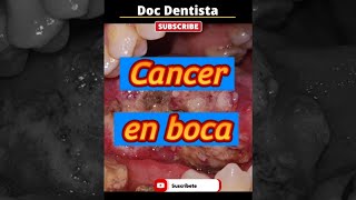 Cancer Carcinoma de Células Escamosas bolitas manchas o abultamientos en la boca m asmr et shorts [upl. by Eicyac]