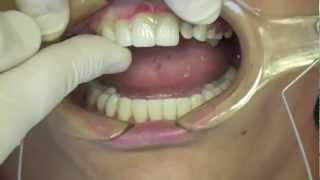 Resin Cementation of eMax Porcelain Veneers and Crowns [upl. by Lounge]