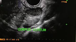 Corpus luteum with peripheral ring of fire USG U ltrasound [upl. by Bamberger236]