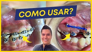 ELÁSTICOS EM CORRENTE 5 FORMAS PRÁTICAS DE USAR EM ORTODONTIA [upl. by Edmonds]