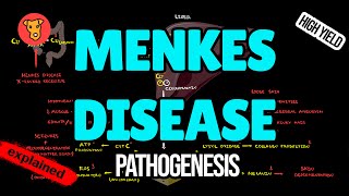 MENKES DISEASE Pathogenesis Clinical symptoms Treatment for USMLE [upl. by Mariejeanne]