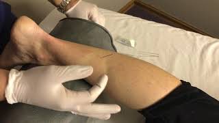 Dry Needling For Heel Pain In a Running Athlete  Columbus Ohio  Dr Daniel Leonard [upl. by Montagu]