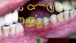 Edident Lab quotDental Upper six unit Porcelain Buildup Part 1quot [upl. by Perice]