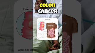 colon cancer symptoms shorts [upl. by Rafi]