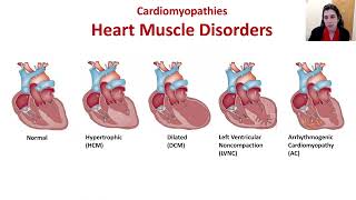 Hypertrophic Cardiomyopathy HCM Identifying Symptoms and Confirming the Diagnosis [upl. by Gotthard]