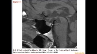 80 Posterior pituitary bright spot ectopic neurohypophysis oxytocin vasopressin endocrinology [upl. by Adnolaj80]