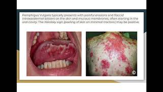 Autoimmune diseases pemphigus vulgaris vs bullous pemphigoid [upl. by Fruin]