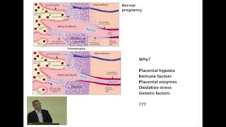 Hypertension in pregnancy [upl. by Ettedualc]