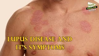 Lupus Disease and its Symptoms  Health Sutra [upl. by Bergerac780]