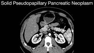 Solid Pseudopapillary Pancreatic Neoplasm [upl. by Sissie]