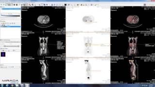 CT PET and Fused PETCT Image Review with Mirada XD3 Fusion [upl. by Aley853]