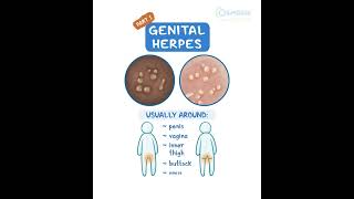 Genital Herpes [upl. by Upshaw]