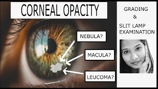 Corneal Opacity  Grading amp Clinical Examination  Adherent Leucoma Nebular Macular amp Leucomatous [upl. by Ringsmuth418]