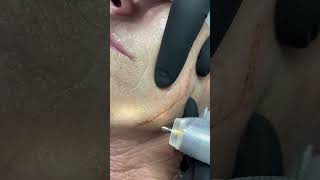 Plasma plasma skintightening [upl. by Tnek]