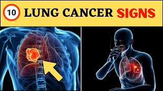 Lung Cancer Warning Signs  10 Lung Cancer Symptoms [upl. by Yntrok]