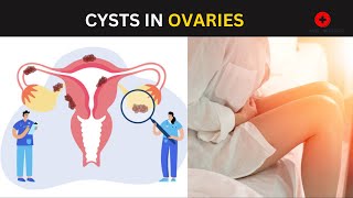 Ovarian Cysts  Types Causes Symptoms amp Treatment [upl. by Blisse]