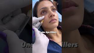 under eye filler treatment helps you get rid of wrinkles  Dermalyn Aesthetics  Dr Muskan Tyagi [upl. by Alemak]