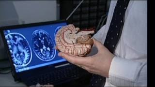 euronews science  La depresión modifica la estructura cerebral [upl. by Eceirtal287]