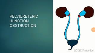 PUJO Pelviureteric junction obstruction Pediatric Surgery [upl. by Harli225]