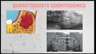 Quistes y tumores odontogenicos parte 1 [upl. by Alaehcim687]