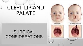 CLEFT LIP PALATESURGICAL CONSIDERATIONS dentabest4493 [upl. by Sholley]