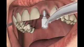 Stanzen statt schneiden bei Zahnimplantaten [upl. by Ecertap]