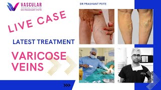 Live case  Varicose veins treatment with Venaseal glue [upl. by Calisa765]