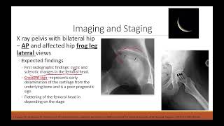 Avascular Necrosis of Femoral Head [upl. by Esinahs]