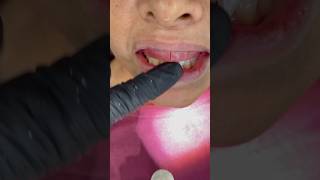 Making a Bite Block fullmouthdentalimplants dentist dental smiledental shorts short denture [upl. by Arakihc]