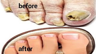 TREAT DAMAGE TOE NAIL REMOVE FUNGI FROM TOE NAILS [upl. by Tolmann]