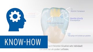 Zolid HT Preshades – Einfärbetutorial 16 aus 7  High Esthetics Methode A1A2 [upl. by Olaf]