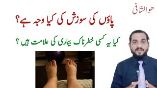 paon ki sujan ka ilaj in urdu  swelling on foot  پاؤں کی سوجن کا علاج [upl. by Jacqui]