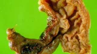 Meckels diverticulum  Pathology mini tutorial [upl. by Yenittirb196]