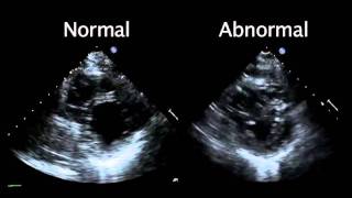 Echocardiogram from the Patient Compared with That from a Normal Control  NEJM [upl. by Berlauda]