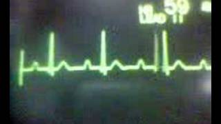 ECG Video AV Block  First Degree [upl. by Eillo]