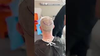 Hairline Restoration  Hair Transplant in Turkey  Longevita [upl. by Hazaki]