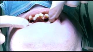 Embarrassing Bodies Dentist  Orthodontics extreme crowding [upl. by Nomra863]